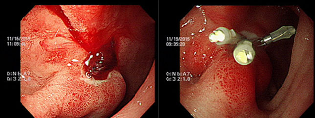 십이지장 구부위 혈괴를 동반한 출혈 / 시술 3일후 치유된 십이지장 궤양