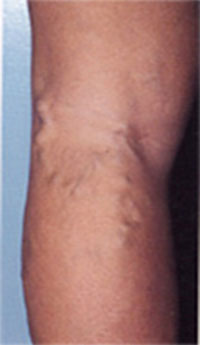 소복재정맥류( Lesser Saphenous Vein )