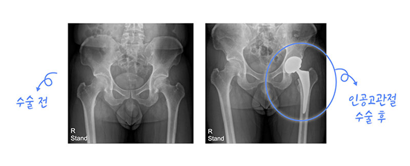 인공고관절 수술 전, 수술 후