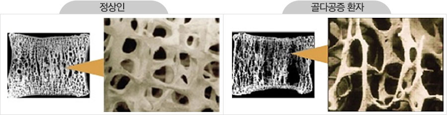 정상인/골다공증 환자
