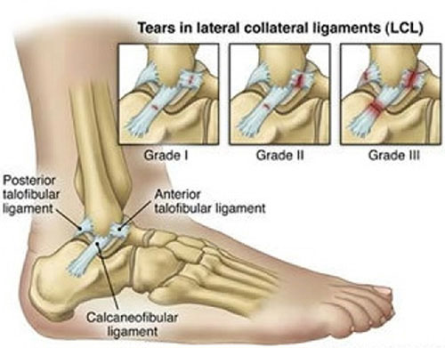 발목 외측부 인대 파열