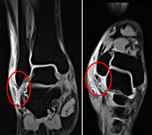 발목 외측부 인대 파열