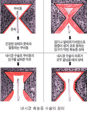 내시경 축농증 수술의 원리