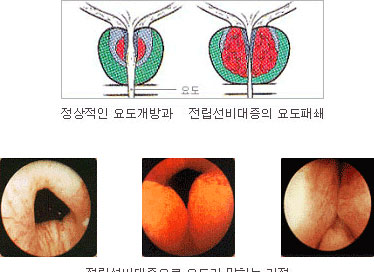 정상적인 요도개방과, 전립선비대증의 요도패쇄