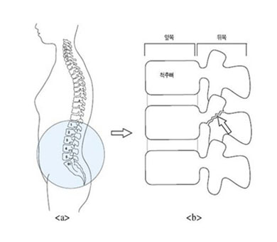 척추분리증술 사진