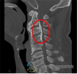 후종인대 골화증 진단 사진