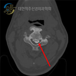 후종인대 골화증 치료 사진