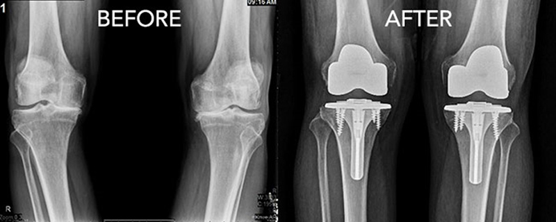 무릎 인공관절 치환술 사진2