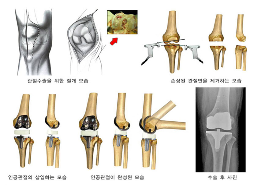 무릎 인공관절 치환술 사진3