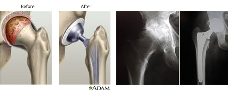 고관절 인공 관절 치환술 사진2