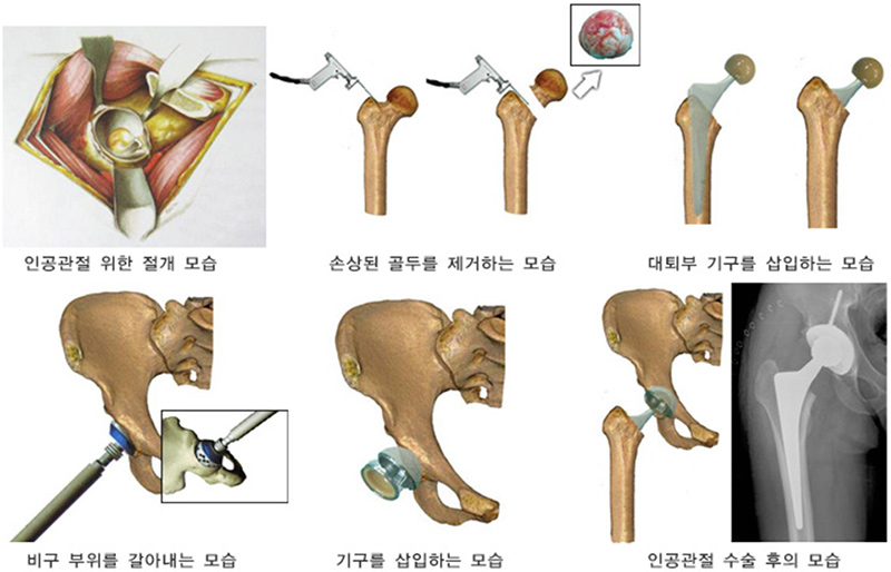 관절 인공관절 치환술 사진