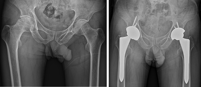 고관절 인공 관절 치환술 증례 사진