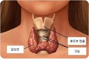 >갑상선 사진