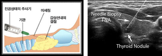 갑상선 종양의 미세침흡인검사