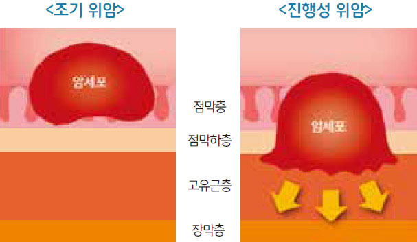 위암이란