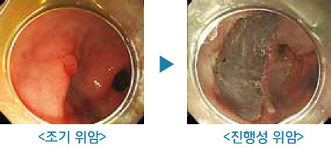 조기위암/진행성위암