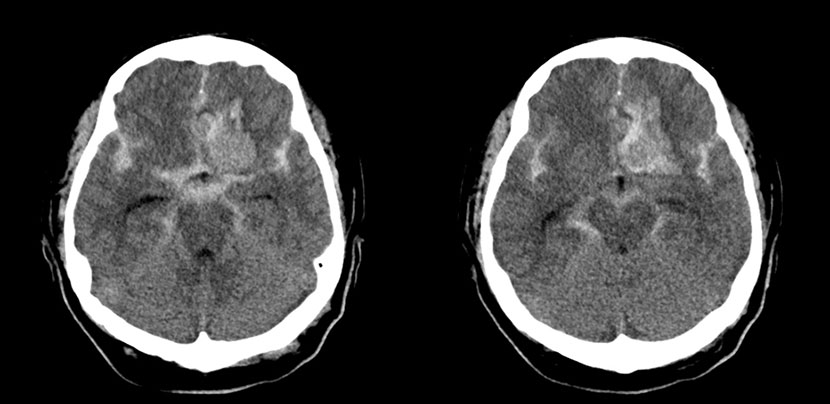수술전 뇌CT 영상에서 뇌지주막하출혈 소견이 보임
