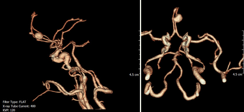 CT 혈관조영술상 뇌동맥류 발견