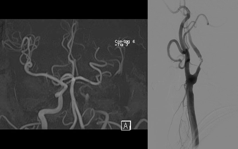 뇌MRA 와 뇌혈관조영술에서 좌측내경동맥의 심한 협착이 보임