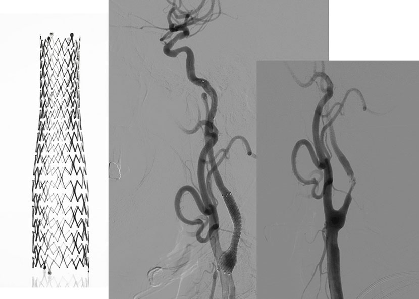 성형술과 스텐트 삽입술을 시행하여, 우측의 수술전 사진과 비교시, 혈관을 넓혀주어 추가적인 뇌경색을 예방
