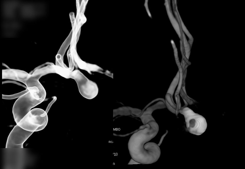 혈관내 코일색전술 후 동맥류 내부에 코일이 들어가 있는 모습