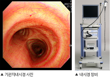 기관지내시경 사진