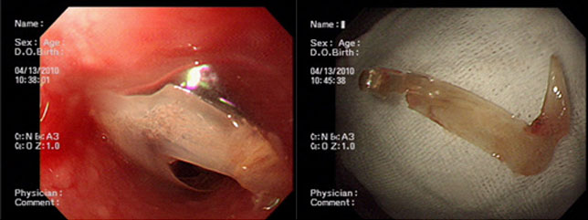 식도 상부에 감입된 생선뼈 / 내시경적 이물 제거 시술후 생선뼈