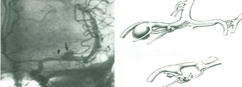 뇌동맥류 클립 시술