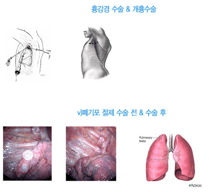흉강경 수술 & 개흉수술, 폐기포 절제 수술 전 & 수술 후