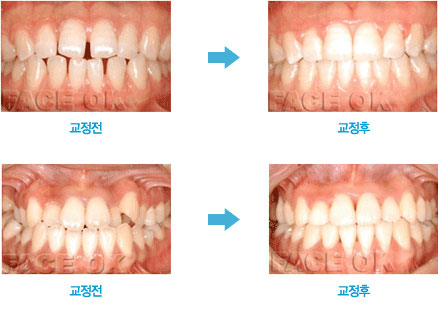 치아 교정전 / 교정후