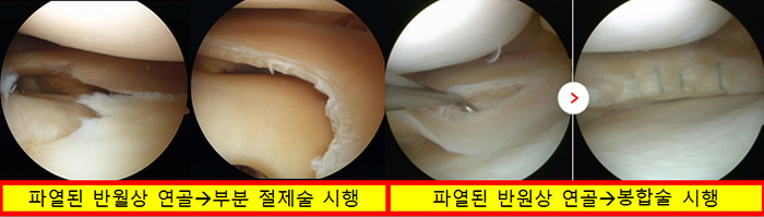 반월상 연골 파열 사진2